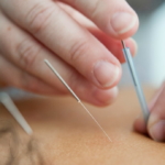 inserting acupuncture needles